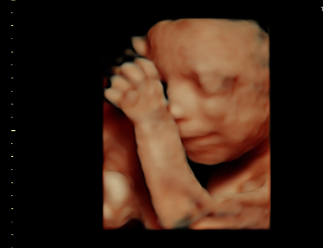 3D ultrasound image at 25 weeks